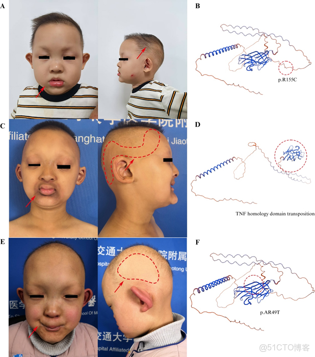 遺傳病、罕見病、腫瘤、家系最新文獻目錄 2025/04/19~11/25 全96篇_建模_03
