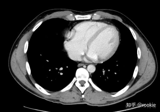 CLAHE算法增強局部對比度的X光圖像增強效果對比_#python 計算對比度_08