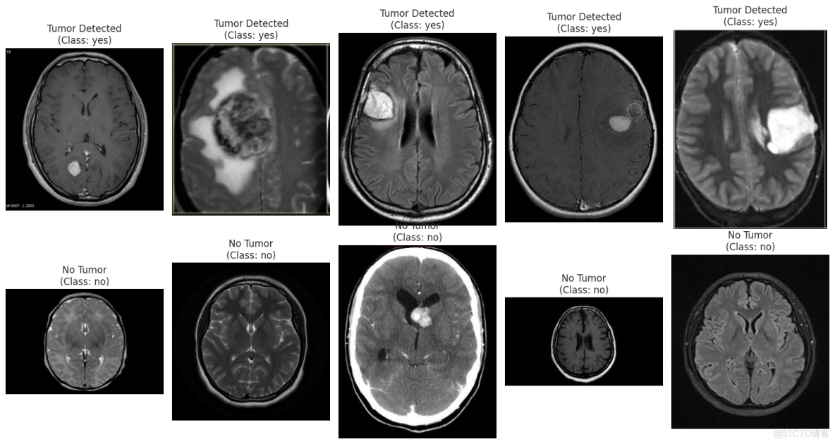深度學習實戰-基於Vision Transformer的腦腫瘤MRI圖像識別_Image_03