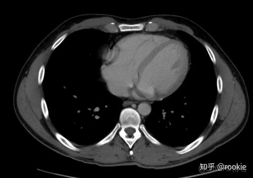 CLAHE算法增強局部對比度的X光圖像增強效果對比_ico_14