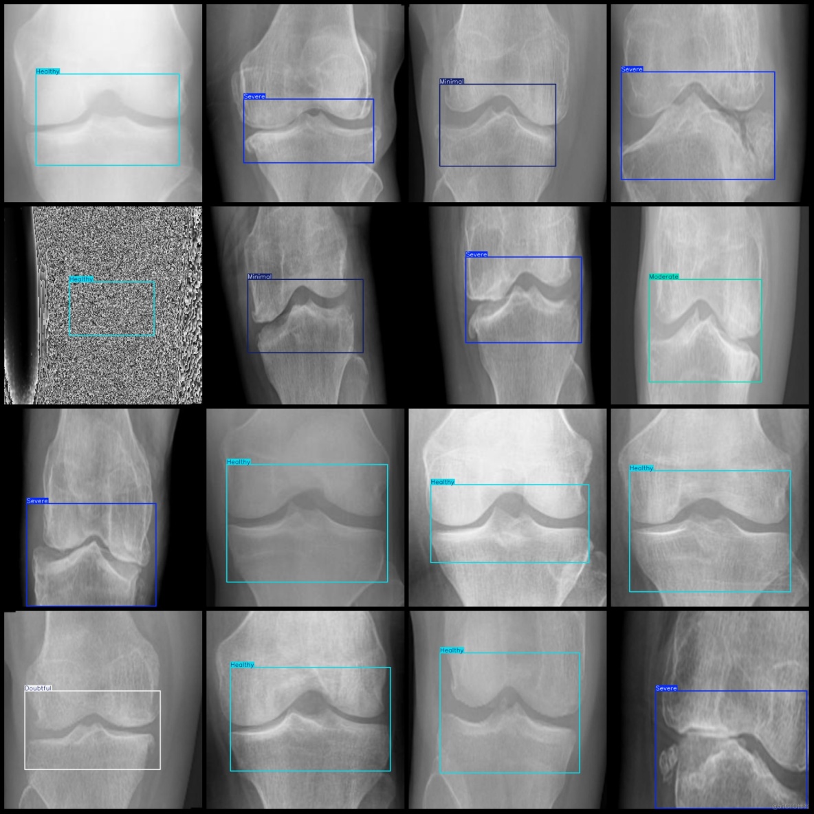 智慧醫療膝蓋骨關節炎嚴重程度檢測數據集VOC+YOLO格式8000張5類別_xml文件_04
