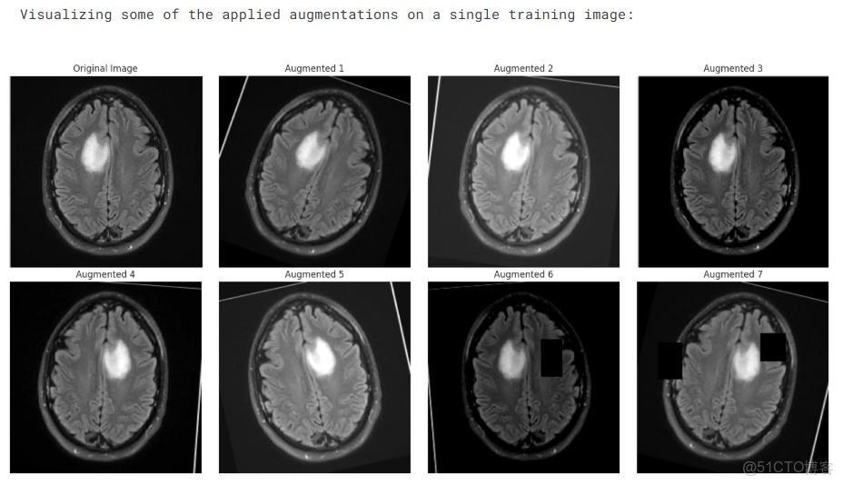 深度學習實戰-基於Vision Transformer的腦腫瘤MRI圖像識別_#深度學習_09