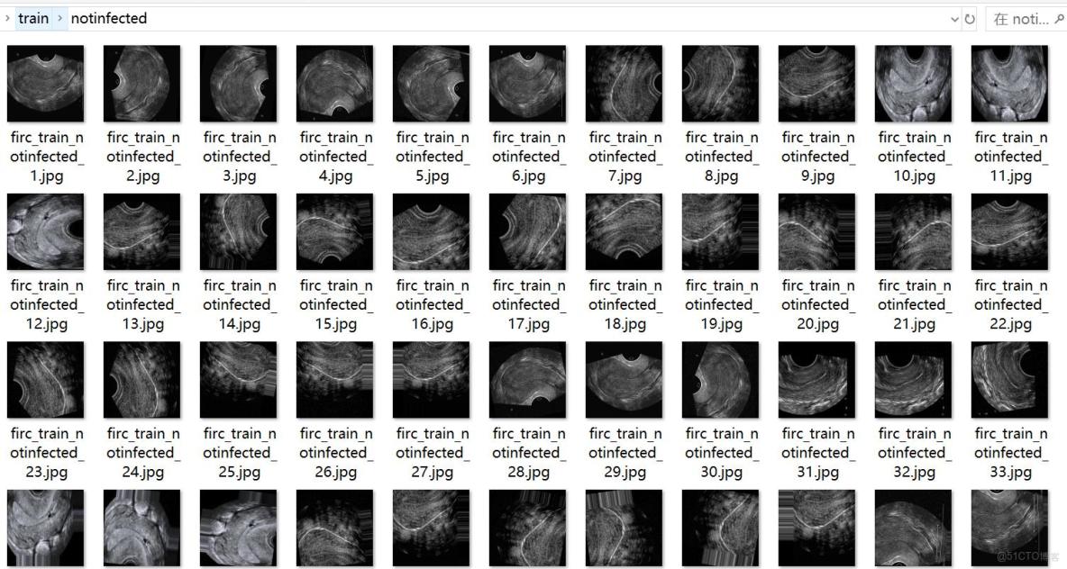 超聲圖像多囊卵巢綜合症分類數據集4637張2類別_圖像分類_02