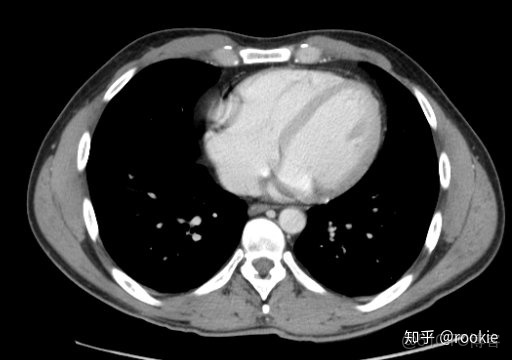 CLAHE算法增強局部對比度的X光圖像增強效果對比_ico_11
