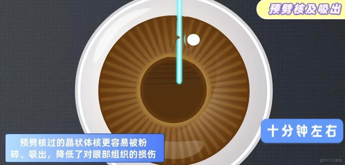 飛秒激光輔助白內障手術，北京愛爾英智眼科醫院丁雪為您解讀_黑科技_02