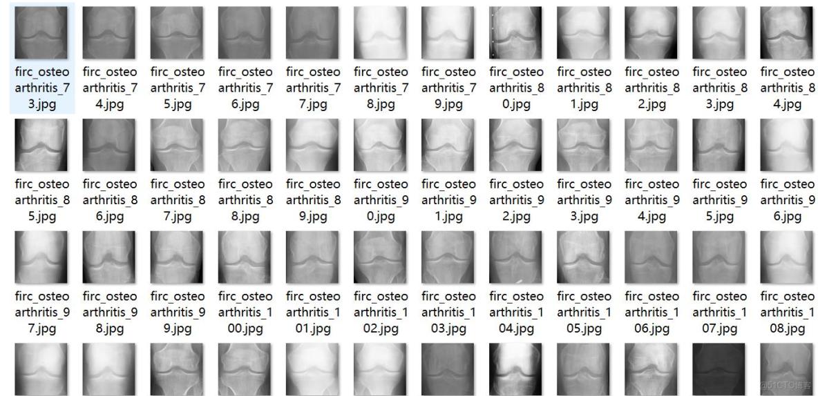 智慧醫療膝蓋骨關節炎嚴重程度檢測數據集VOC+YOLO格式8000張5類別_xml文件