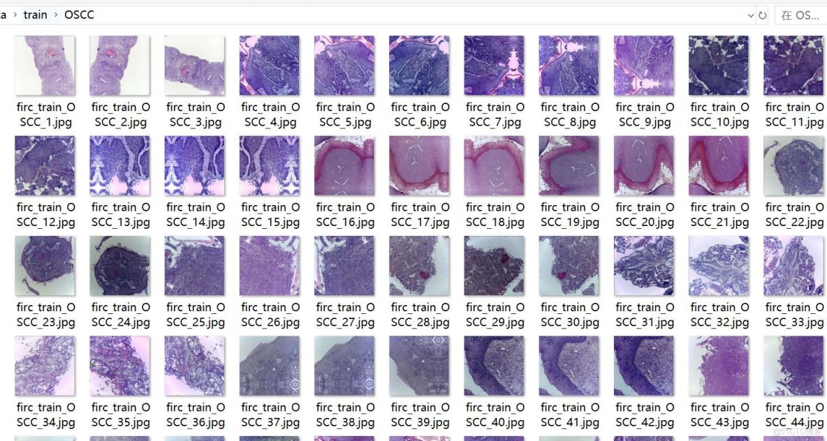 口腔癌病理染色組織切片圖片分類數據集11303張2類別_圖像分類_02