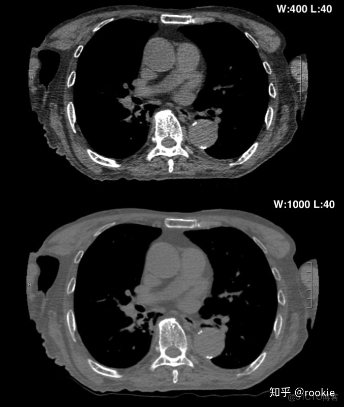 CLAHE算法增強局部對比度的X光圖像增強效果對比_f5_06