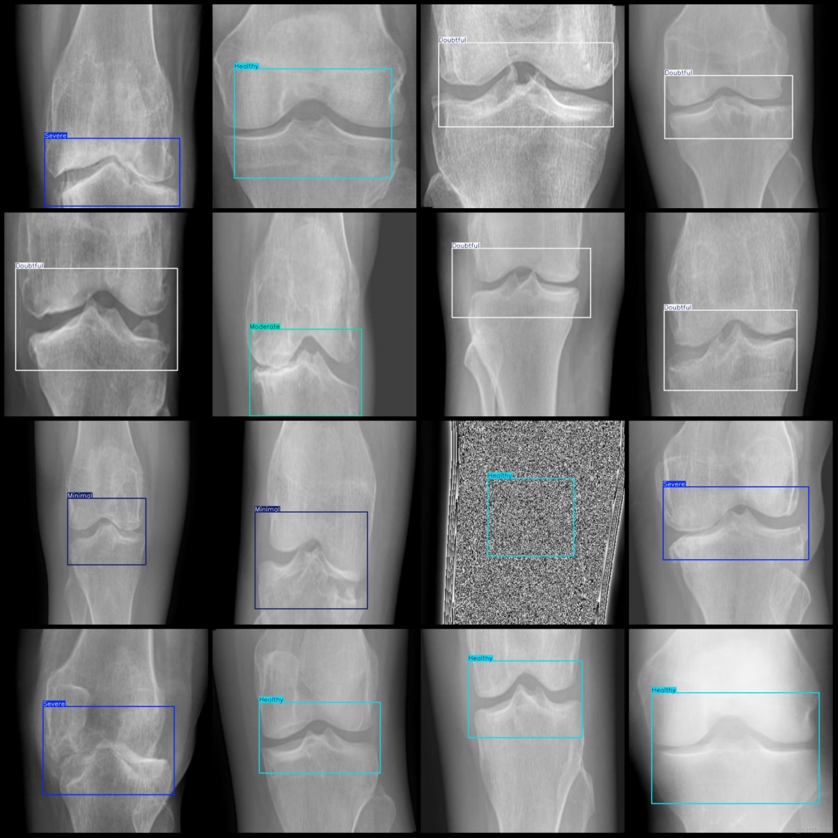 智慧醫療膝蓋骨關節炎嚴重程度檢測數據集VOC+YOLO格式8000張5類別_txt文件_03